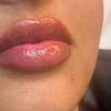 Image 1: Revolax 1ml Dermal Lip Filler Treatment Including Consultation