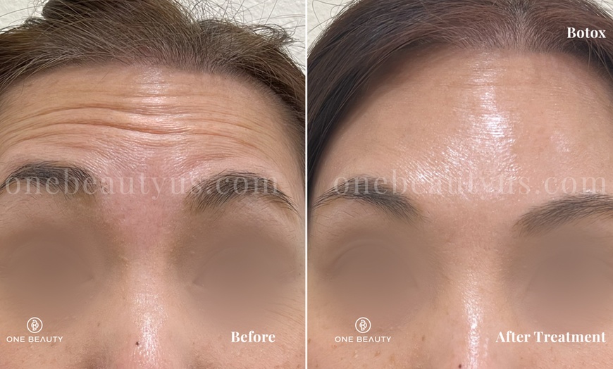 Image 4: Up to 51% Off on Injection - Botox at One Beauty Aesthetics