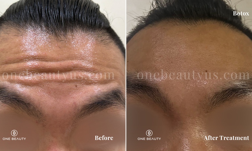 Image 1: Up to 51% Off on Injection - Botox at One Beauty Aesthetics