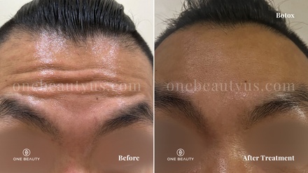 20 Units of Botox Injection - One Beauty Aesthetics