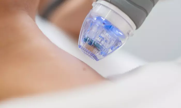 Experience Microneedling Magic for Smooth Skin