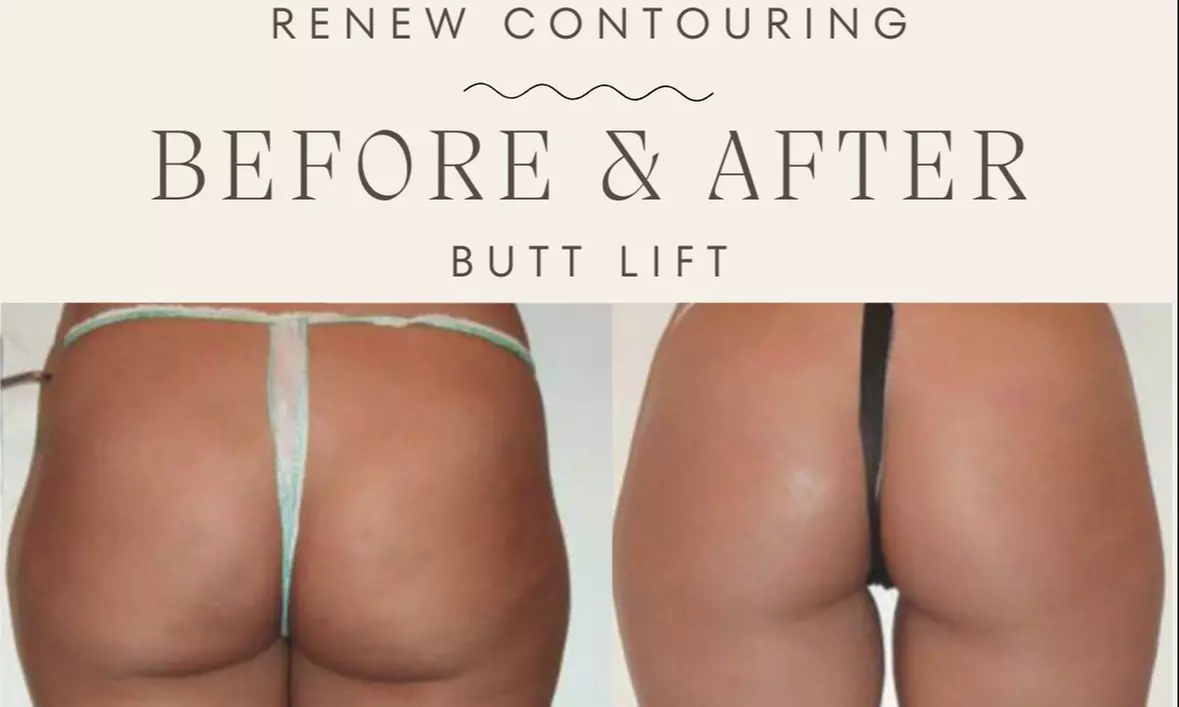 Experience Non-Surgical Butt Lift with Therma-Lift Sessions
