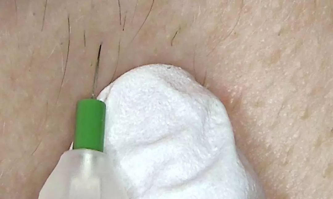 One, Six, or Ten 30 or 60-Minute Electrolysis Sessions