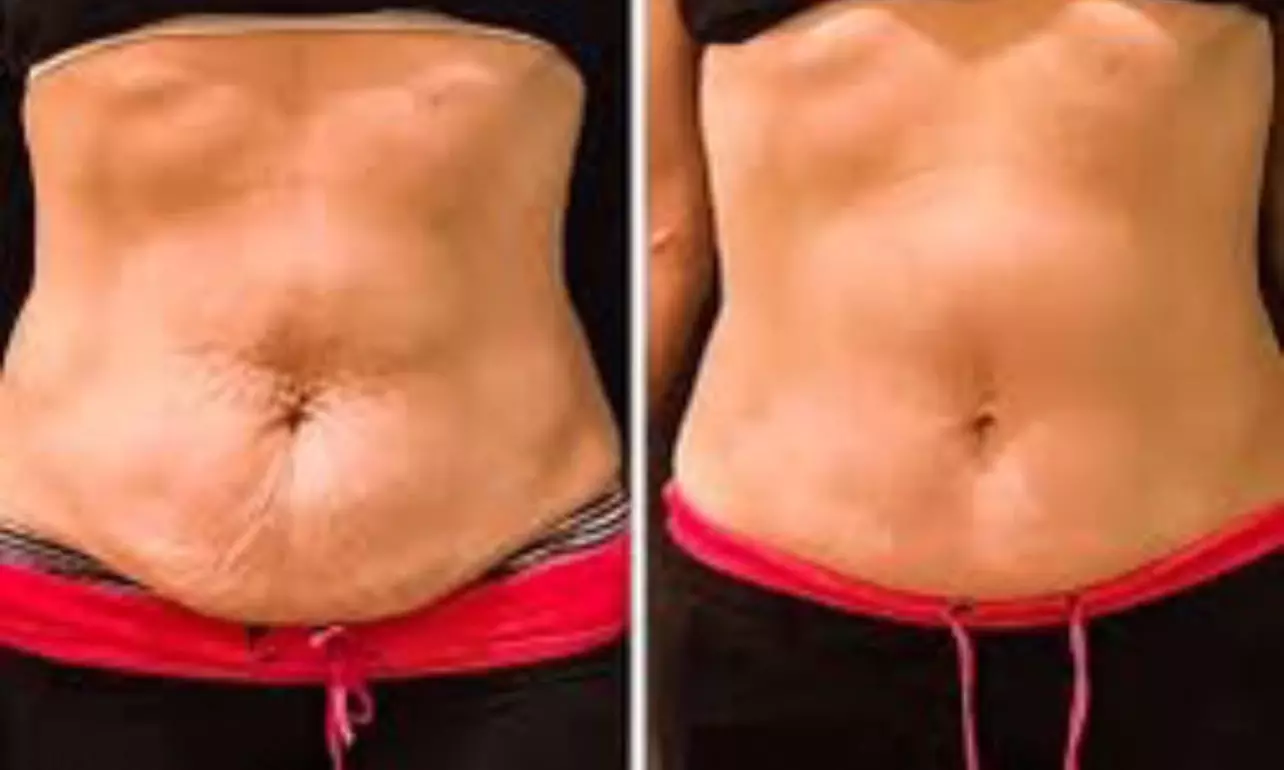 Redefine Body with One, Four or Eight Fat Reduction Sessions