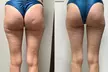 Up to 50% Off on Endermologie at Love Your Body Endermologie  West Hollywood - Second Medium