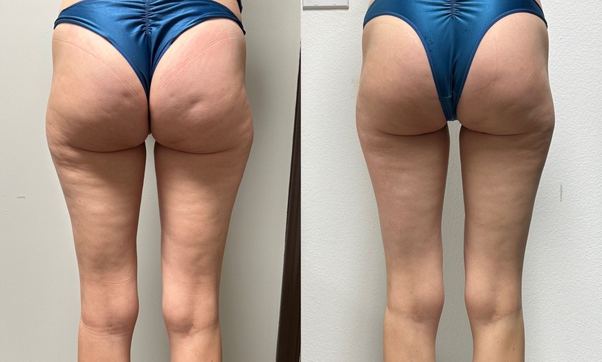 Image 4: Up to 55% Off on Endermologie at Love Your Body Endermologie  West Hollywood