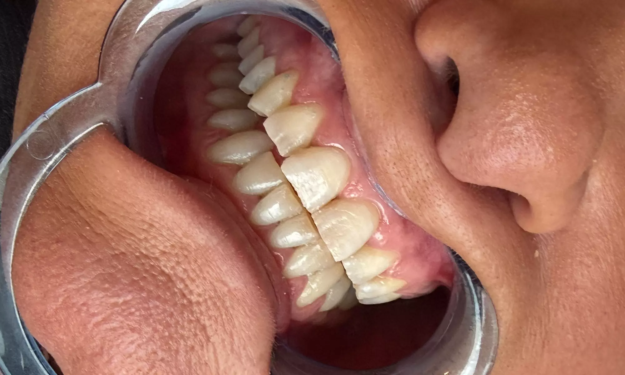 1 ou 2 séances de blanchiment dentaire au choix chez L’atelier de Chloé (jusqu'à 55% de remise) - Second Medium