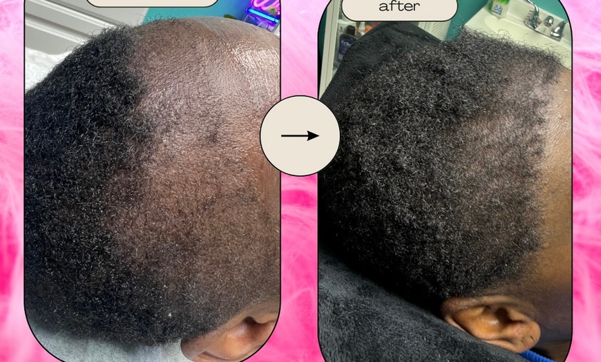 Image 5: Up to 60% Off on Hair Restoration - Non-Surgical at Aesthetics Care Med Spa
