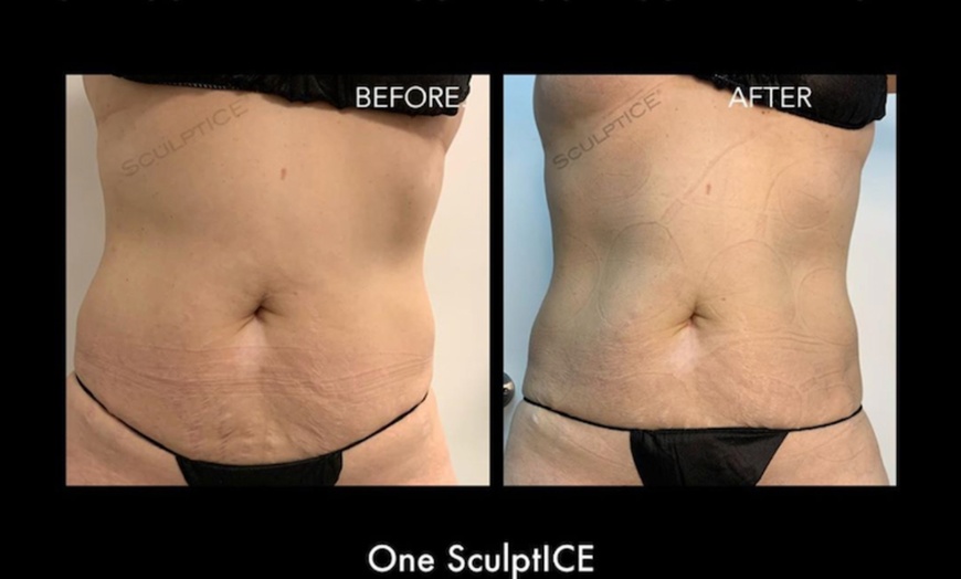 Image 1: Non-invasive 1 or 2 Body Ice Sculpting Treatments