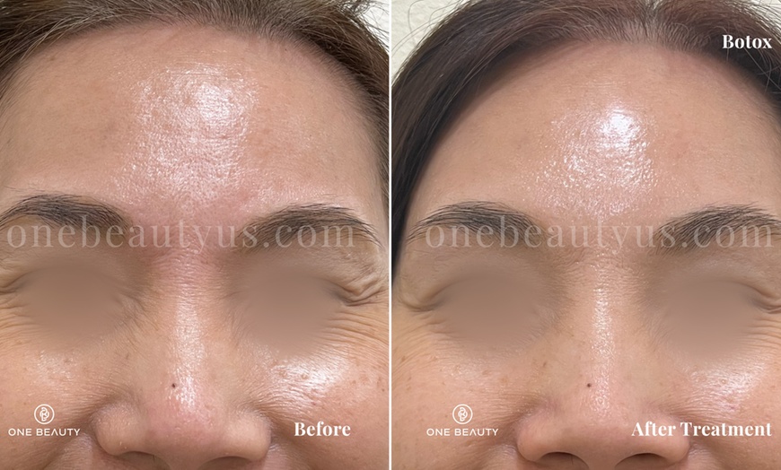 Image 5: Up to 51% Off on Injection - Botox at One Beauty Aesthetics