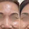 Image 5: Up to 51% Off on Injection - Botox at One Beauty Aesthetics