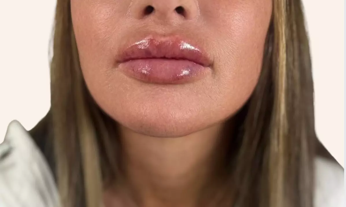 Rejuvenate with One Half or Full Syringe of Revanesse Versa