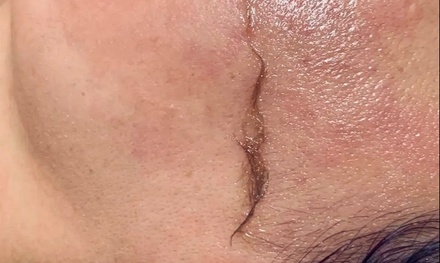 Dermaplaning Treatment with Pumpkin Enzyme Peel - Essence Esthetics