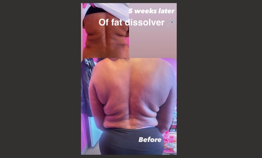 Image 2: Up to 51% Off on Fat Reduction at Arewa Essential Medspa