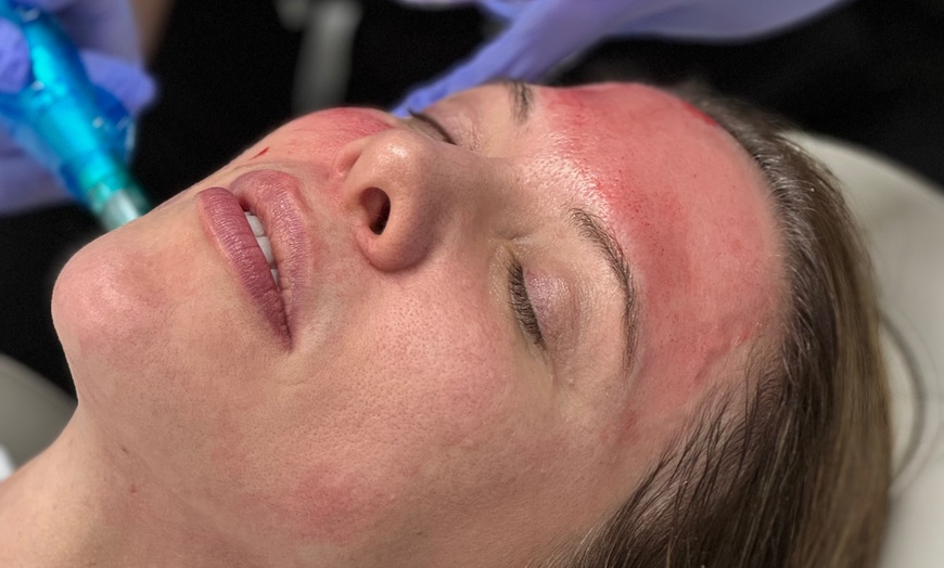 Image 3: Up to 63% Off on Micro-Needling at R3 Anti Aging & Medspa