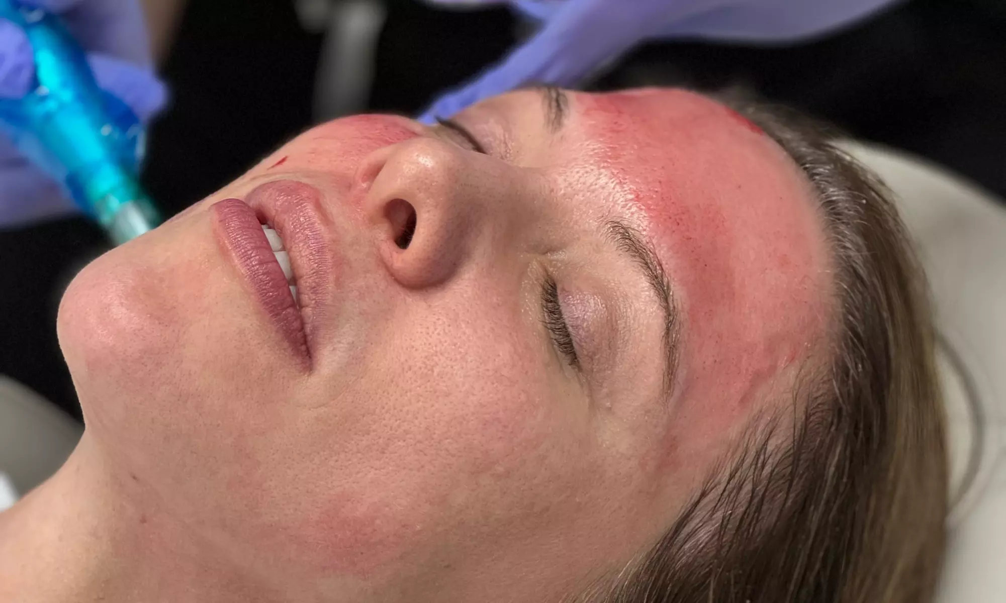 Up to 67% Off on Micro-Needling at R3 Anti Aging & Medspa - Second Medium