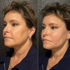 Image 7: Up to 64% Off on Facelift - Thread Lift at DermAlign Medical Aesthetics