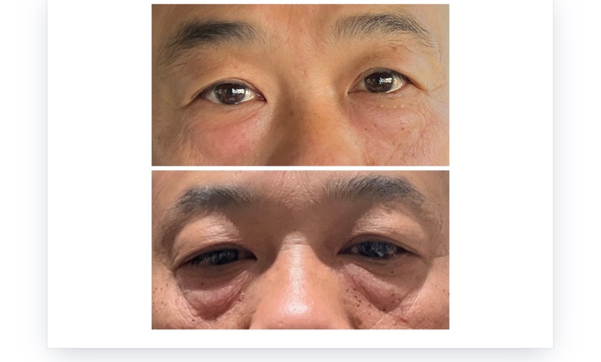 Image 2: DOT Plasma For Wrinkles: Crows Feet, Forehead, Around the Mouth!
