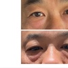Image 2: DOT Plasma For Wrinkles: Crows Feet, Forehead, Around the Mouth!