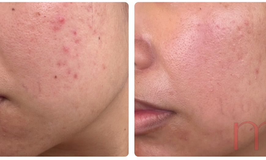 Image 5: Experience rejuvenating microneedling for face and neck