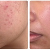 Image 5: Experience rejuvenating microneedling for face and neck
