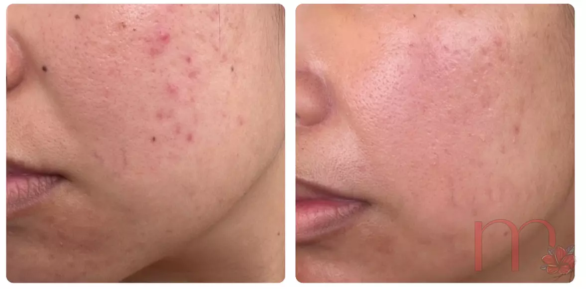 Experience rejuvenating microneedling for face and neck