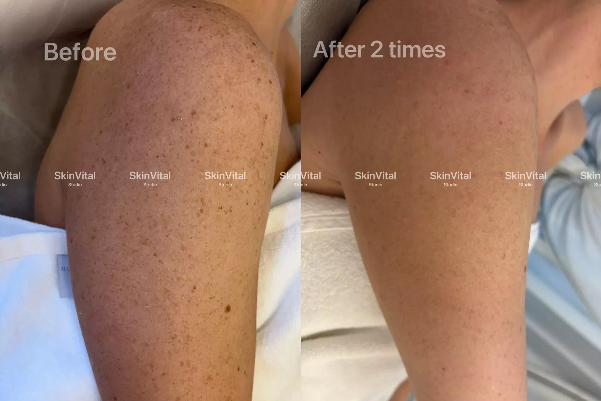 ✨ IPL-Intense Pulse Light Therapy at SkinVital Studio