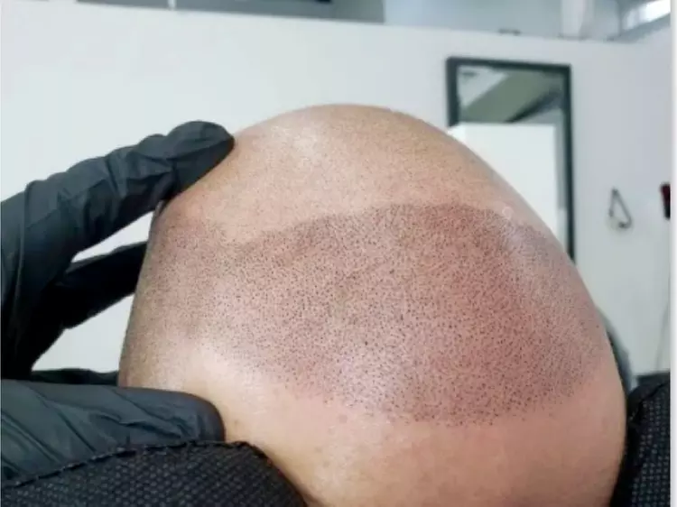 Up to 56% Off on Hair Restoration - Non-Surgical at Skalp ink micropigmentation - Primary Image