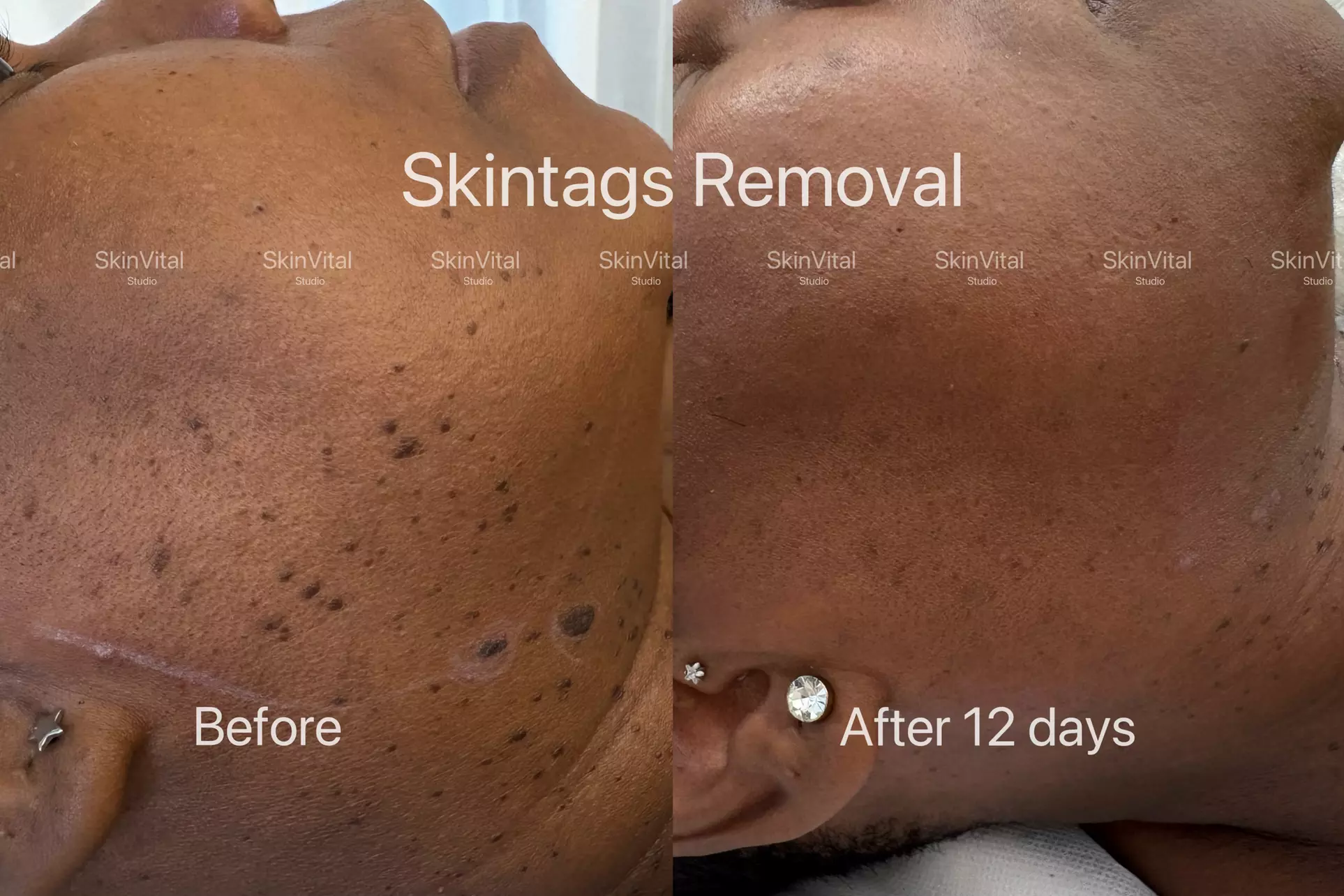 Removal of up to 3, 5,/10 Skin Tags, Cherry Angiomas & More(2mm Size)