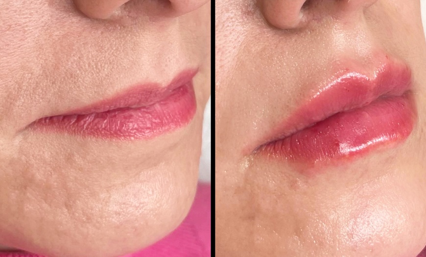 Image 2: Up to 63% Off on Injection - Dermal Filler at The Nordic Skin Clinic