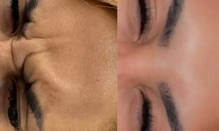 Radiant Renewal with Xeomin & Versa Treatments