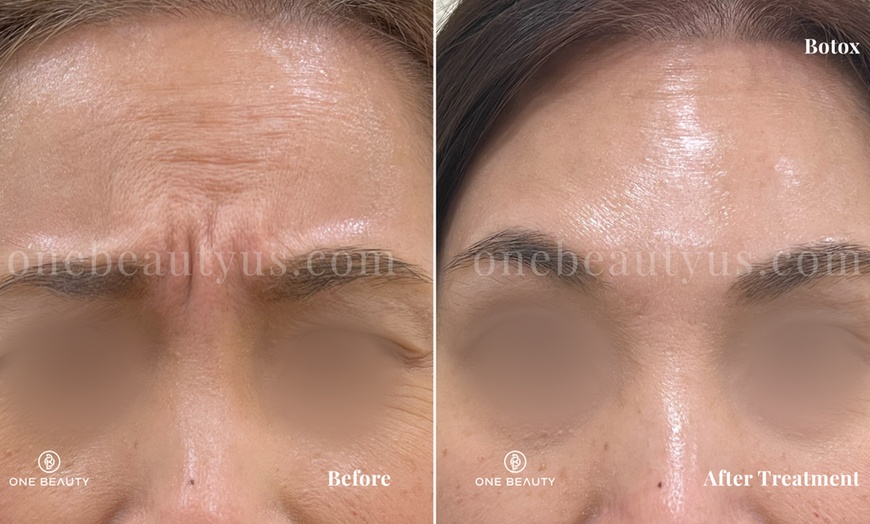 Image 6: Up to 51% Off on Injection - Botox at One Beauty Aesthetics