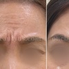 Image 6: Up to 51% Off on Injection - Botox at One Beauty Aesthetics