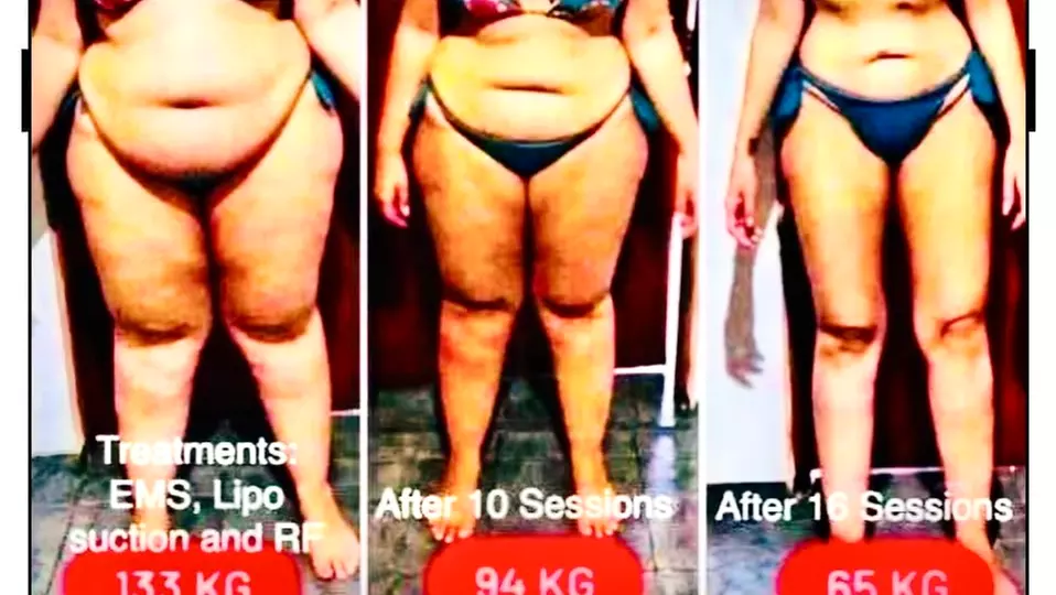 Up to 71% Off on Lipo - Non-Invasive Laser-iLipo at Body Sculpture by Carmen