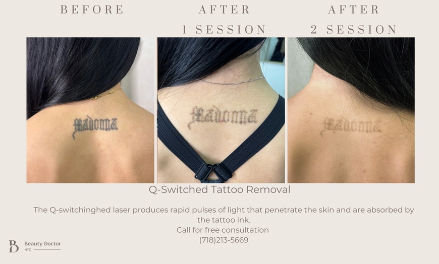 Image 1: Up to 50% Off on Tattoo Removal at Beauty Doctor NYC