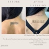 Image 1: Up to 50% Off on Tattoo Removal at Beauty Doctor NYC