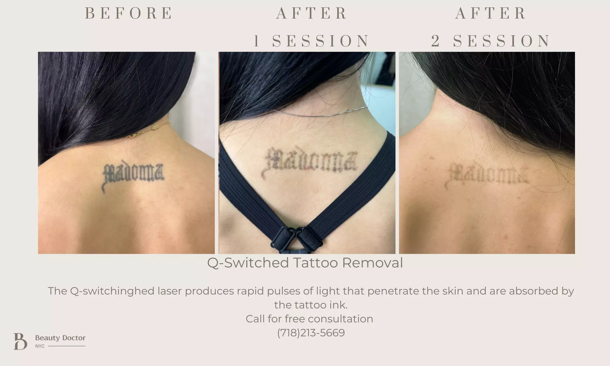 Up to 50% Off on Tattoo Removal at Beauty Doctor NYC - Primary Image