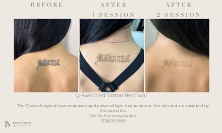 Three Laser Tattoo Removal Sessions on a Extra Small Area - Beauty Doctor NYC
