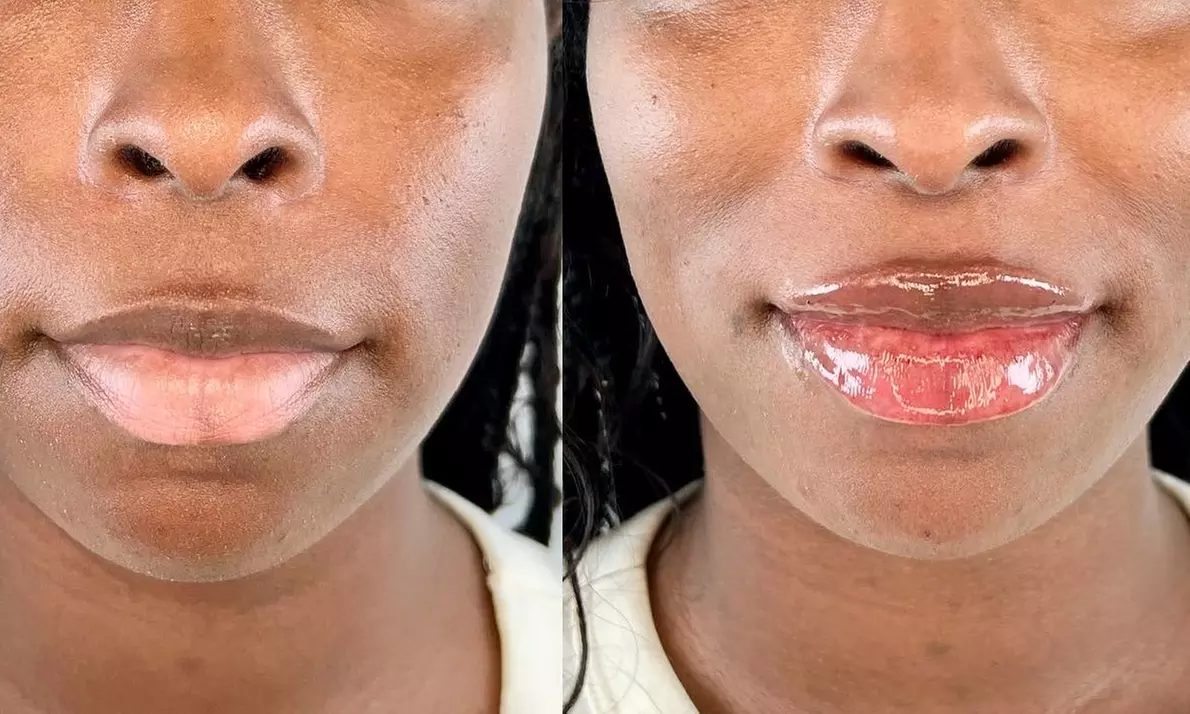 Up to 31% Off on Lip Enhancement at Charette Cosmetics Medical Spa - Second Medium