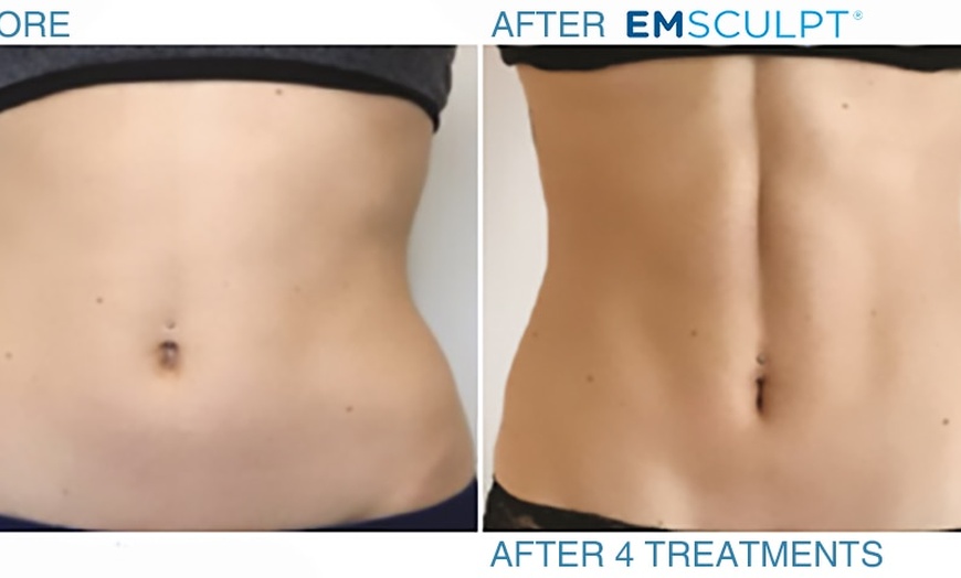 Image 2: Electromagnetic Muscle Stimulation And Body Contouring