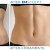 Image 2: Electromagnetic Muscle Stimulation And Body Contouring