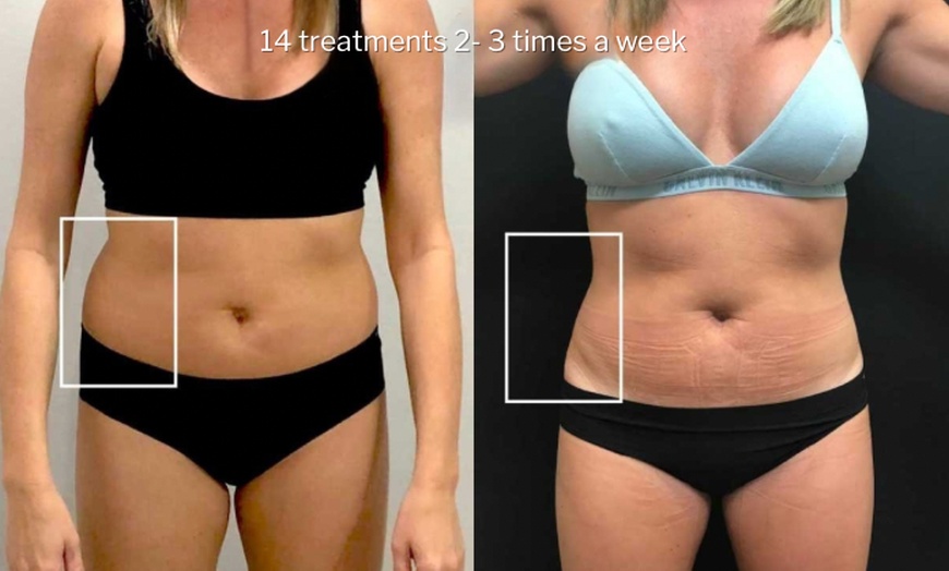 Image 7: Green Laser Lipo Fat Reduction - Up To 4 inches Loss