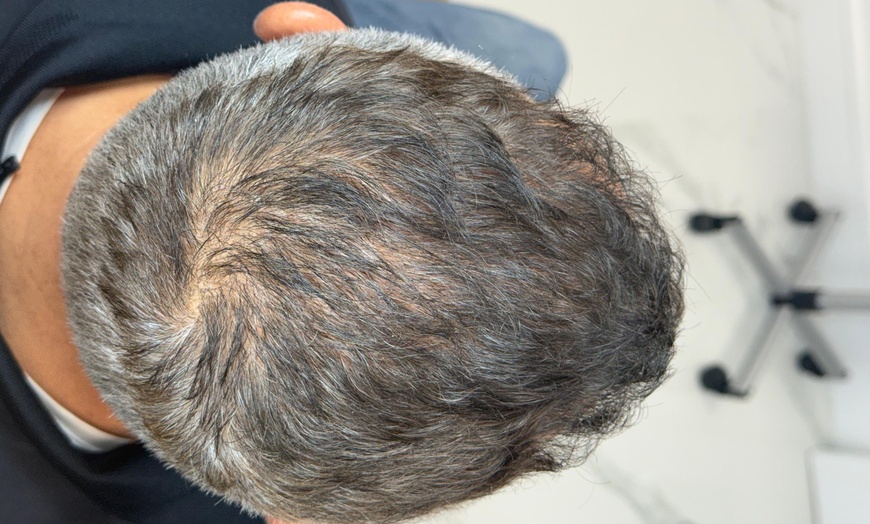 Image 4: Up to 64% Off on Hair Restoration - Non-Surgical at Estetika Med Spa