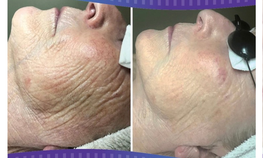 Image 1: Rejuvenate: Procell Therapies: Face & Neck or Stretch Marks & More