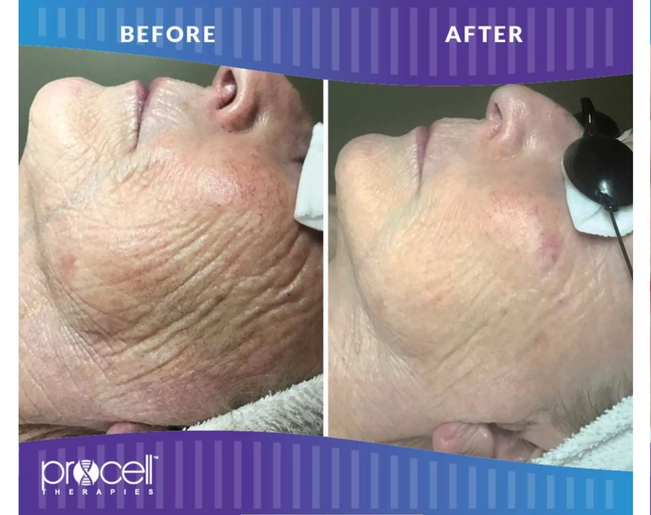 Rejuvenate with Procell Therapies: Face & Neck or Stretch Marks & More (Up to 37% Off) at Nouveau Toi Med Spa - Primary Image