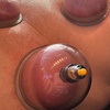 Image 2: Up to 37% Off on Cupping at Navigate Health Chiropractic