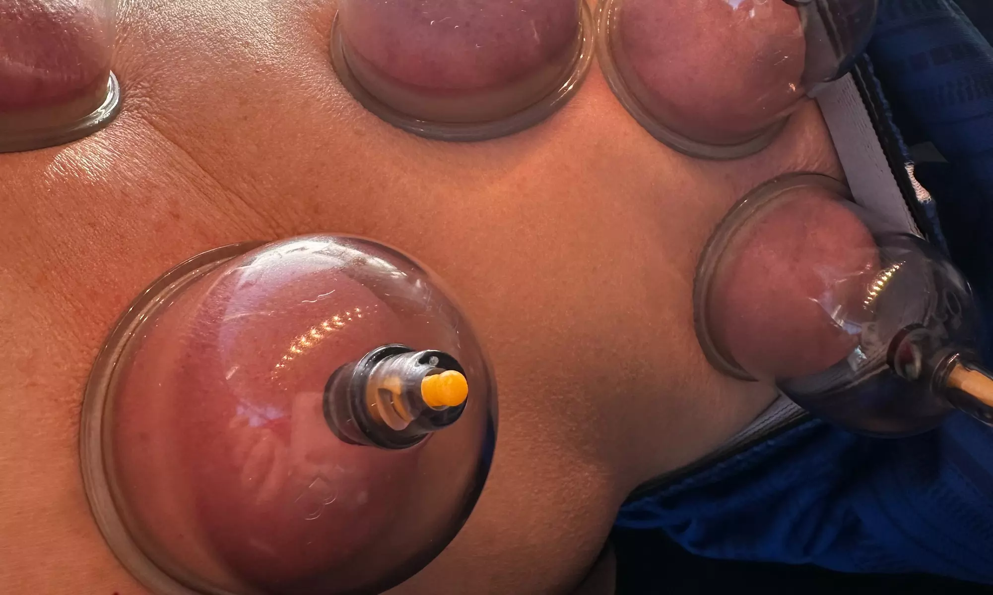Up to 30% Off on Cupping at Navigate Health Chiropractic