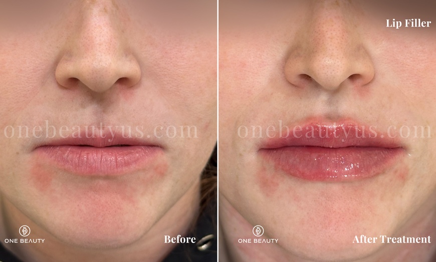 Image 5: Up to 52% Off on Injection - Dermal Filler at One Beauty Aesthetics