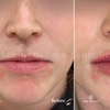 Image 5: Up to 52% Off on Injection - Dermal Filler at One Beauty Aesthetics