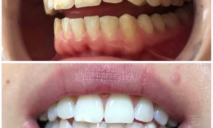 Image 4: Signature Teeth Whitening or Signature Teeth Whitening Package of 3
